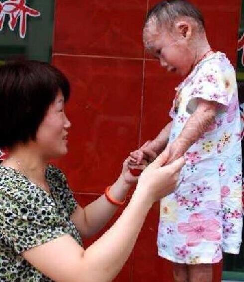 如懿传火棉胶婴儿能治好吗?火棉胶婴儿长大后图片