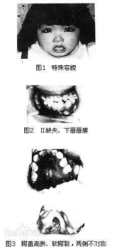 ���輿�����ۺ�����֢״��Ƭ����ױ��һ�����ⲡ����������