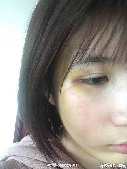 许凯家暴大金的照片曝光,大金的脸被打青