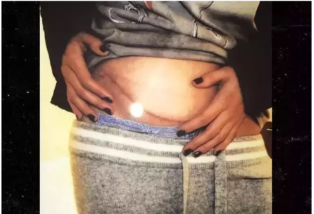 赛琳娜为什么叫傻脸妹?赛琳娜戈麦斯换肾后能活多久