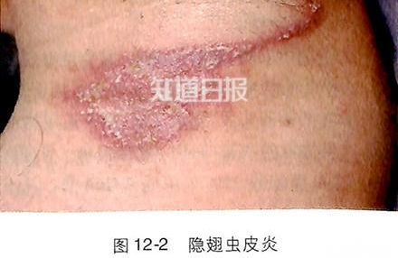 隐翅虫咬人后的图片,隐翅虫的天敌克星是什么?