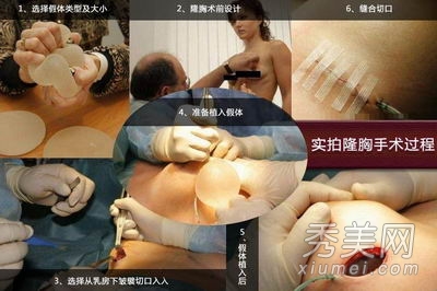 超震撼!实拍美女假体隆胸手术全过程