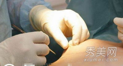 超震撼!实拍美女假体隆胸手术全过程