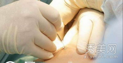 超震撼!实拍美女假体隆胸手术全过程