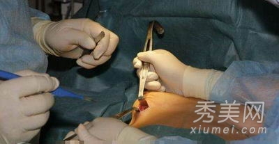 超震撼!实拍美女假体隆胸手术全过程
