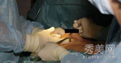 超震撼!实拍美女假体隆胸手术全过程