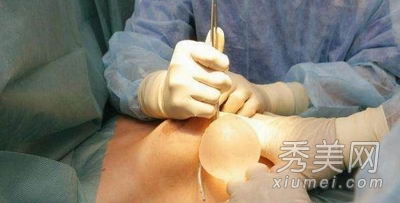 超震撼!实拍美女假体隆胸手术全过程