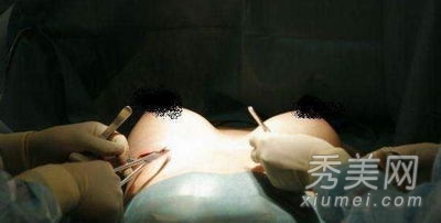 超震撼!实拍美女假体隆胸手术全过程