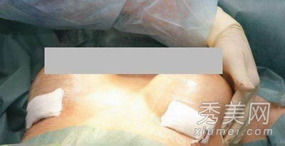 超震撼!实拍美女假体隆胸手术全过程
