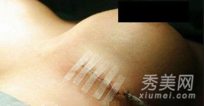 超震撼!实拍美女假体隆胸手术全过程
