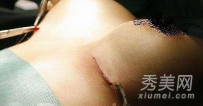 超震撼!实拍美女假体隆胸手术全过程