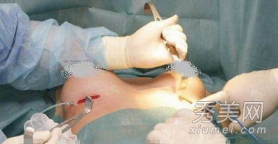 超震撼!实拍美女假体隆胸手术全过程