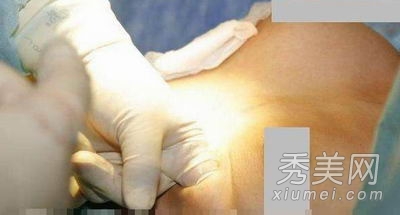 超震撼!实拍美女假体隆胸手术全过程