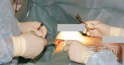 超震撼!实拍美女假体隆胸手术全过程