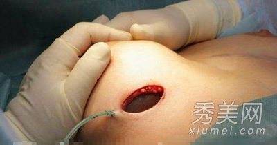 超震撼!实拍美女假体隆胸手术全过程