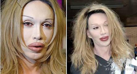 图揭20位最吓人的整形失败女星案例