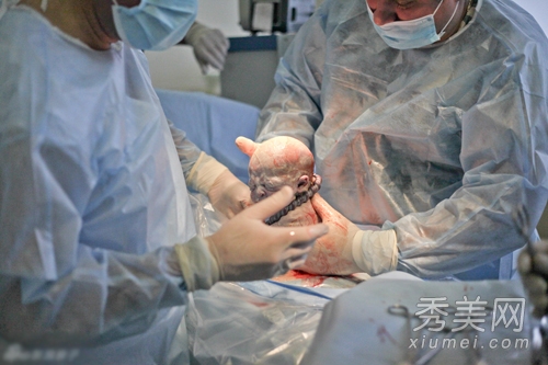 产房直击 实拍剖腹产手术全过程图片