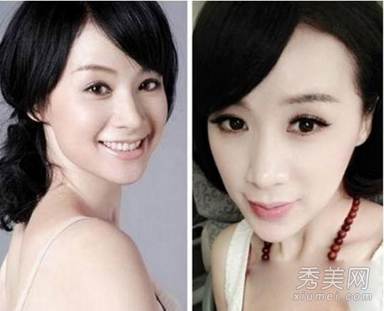 官恩娜面瘫嘴歪眼斜 明星整容后遗症可怕