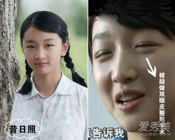 周冬雨被疑整容 看90后女星整容对比照