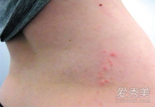 ����ҧ��֢״ ����ҧ����ʲôΣ��