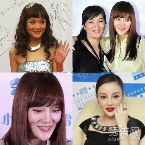 巩新亮整容失败眼珠都快掉了 女星整容失败案例