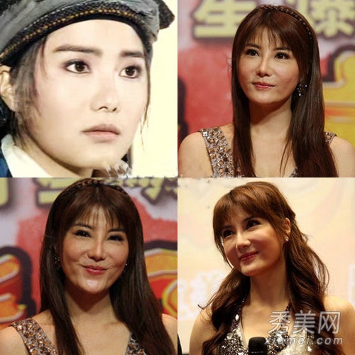 巩新亮整容失败眼珠都快掉了 女星整容失败案例