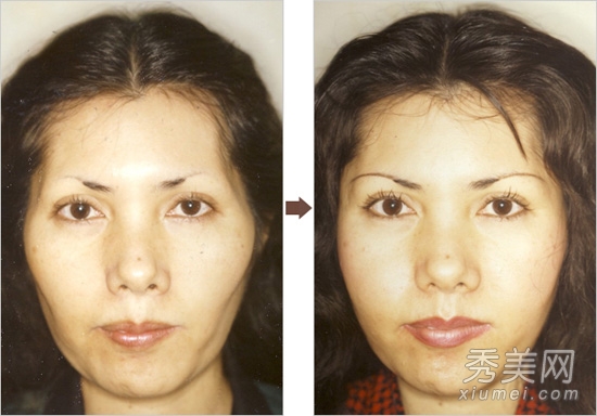 图揭丑女大翻身 日本整形医院患者照片