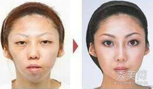 图揭丑女大翻身 日本整形医院患者照片