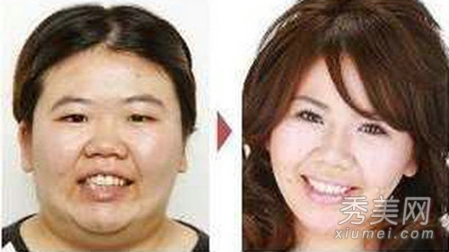 图揭丑女大翻身 日本整形医院患者照片
