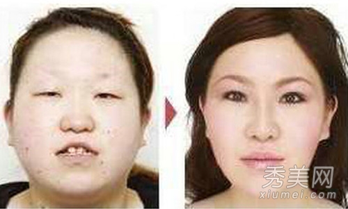图揭丑女大翻身 日本整形医院患者照片