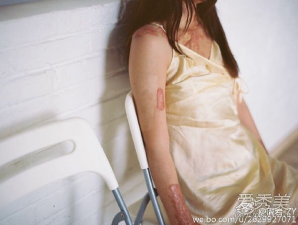 毁容少女晒写真 周岩毁容前照片个人资料微博_周岩事件真相