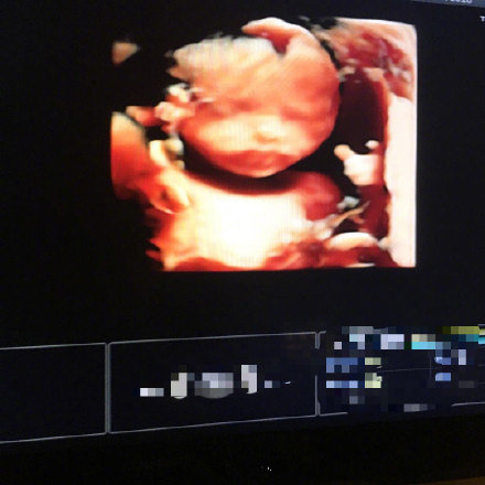 ŷ��ɹ���Ӷ�̥B��������ô���� ŷ�����Ӷ�̥Ԥ������ʲôʱ��