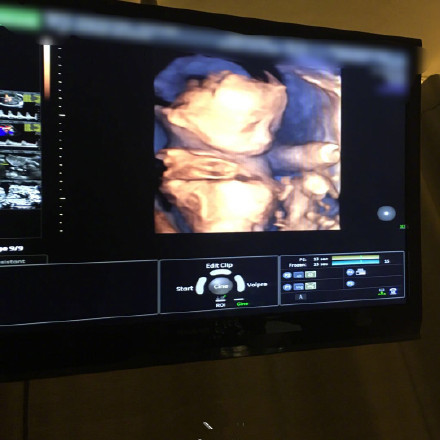 ŷ��ɹ���Ӷ�̥B��������ô���� ŷ�����Ӷ�̥Ԥ������ʲôʱ��