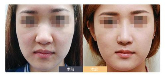 鼻翼宽大怎么缩小 鼻翼宽大能捏小么