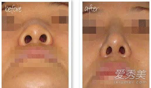 鼻翼宽大怎么缩小 鼻翼宽大能捏小么