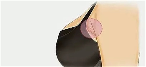 假副乳怎么消除 假副乳和真副乳的区别是什么