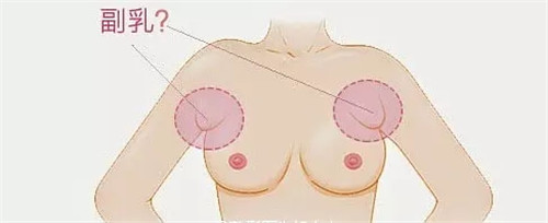 假副乳怎么消除 假副乳和真副乳的区别是什么