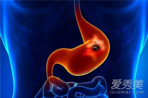 什么情况需要肠镜检查 6种症状需做肠镜检查