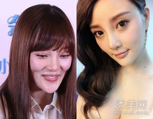 崔智友整容后遗症变残 揭女星整容对比照