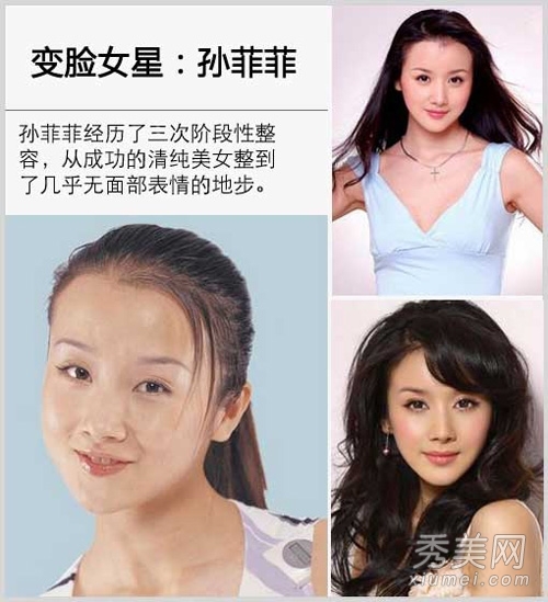 崔智友整容后遗症变残 揭女星整容对比照