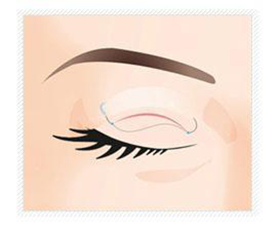 ˫��Ƥ������������ ����˫��Ƥ����ȱ��_����˫��Ƥ����