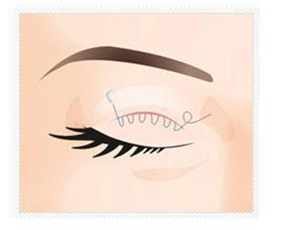 ˫��Ƥ������������ ����˫��Ƥ����ȱ��_����˫��Ƥ����