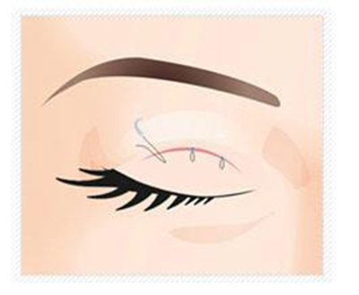 ˫��Ƥ������������ ����˫��Ƥ����ȱ��_����˫��Ƥ����