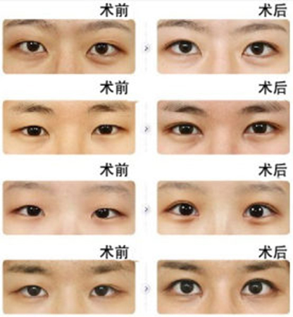 ˫��Ƥ������������ ����˫��Ƥ����ȱ��_����˫��Ƥ����