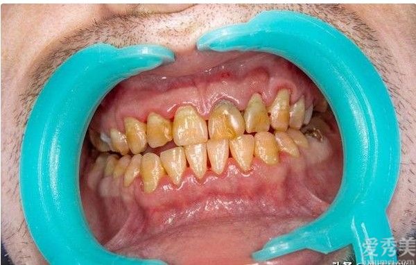 年龄大过牙齿会掉光吗?哪些方面会导致牙周炎?要留意牙齿护理