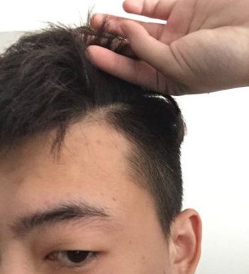 鬓角脱发还能长出来吗 鬓角脱发是什么原因导致的